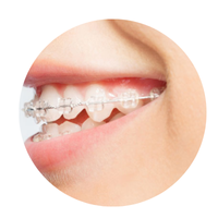 Invisalign Aligners