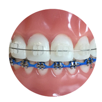 Invisalign Aligners