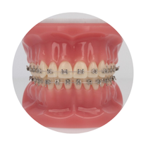 Invisalign Aligners